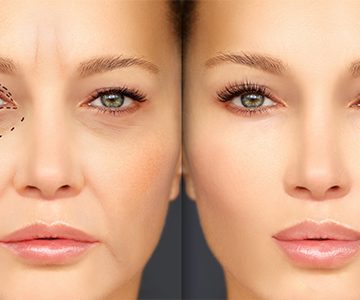 لیزر موهای زائد