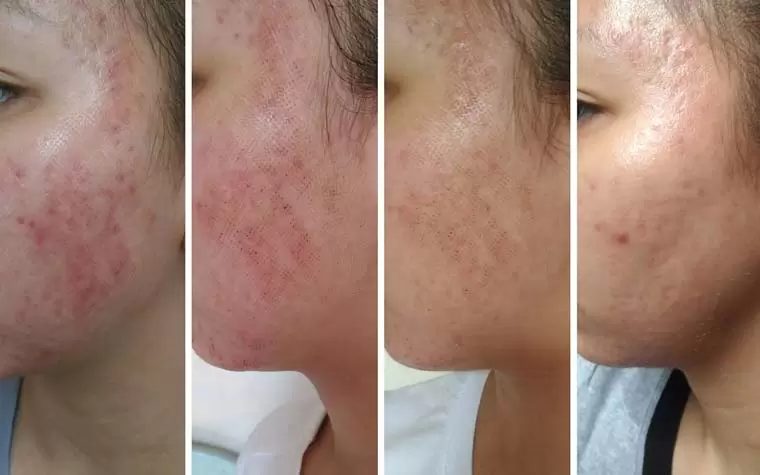 دلایل ایجاد جوش پس از لیزر