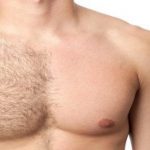 هزینه لیزر موهای زائد در اصفهان