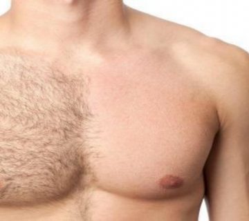 هزینه لیزر موهای زائد در اصفهان