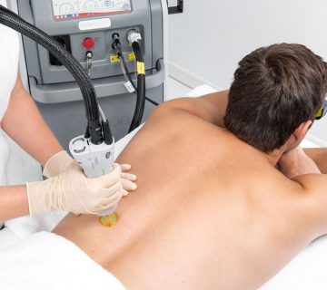 لیزر موهای زائد آقایان در اصفهان