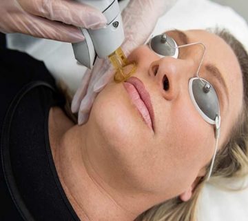 لیزر موهای زائد صورت در اصفهان